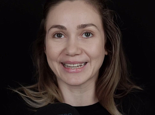 Отзыв одномоментная имплантация